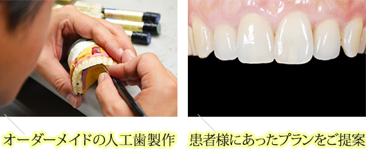 	オーダーメイドの人工歯制作・患者様に合ったプランをご提案